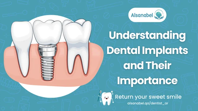 Dental Implants