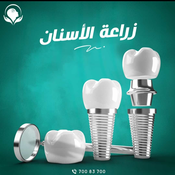 زراعة الأسنان الخيار الأمثل لاستعادة المظهر الجمالى