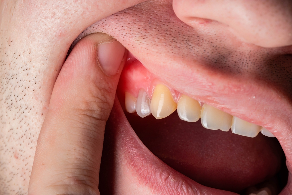 خراج الأسنان: أعراضه وكيف يتم تشخيصه وعلاجه داخل مركز السنابل