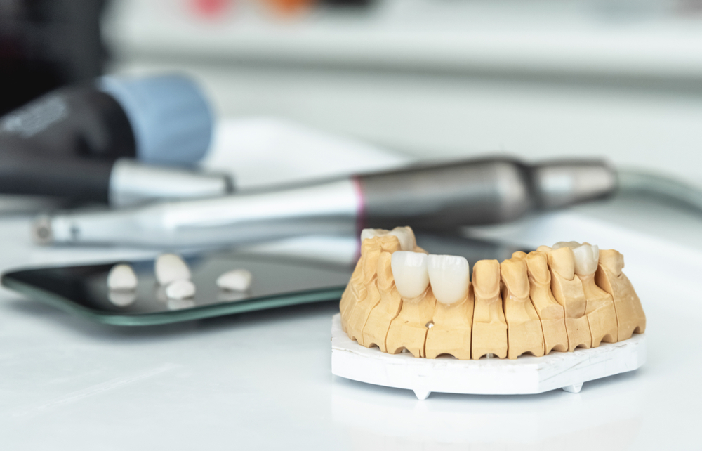 تجميل الأسنان الذكي :لومينير الاسنان (Lumineers) - مركز السنابل للأسنان