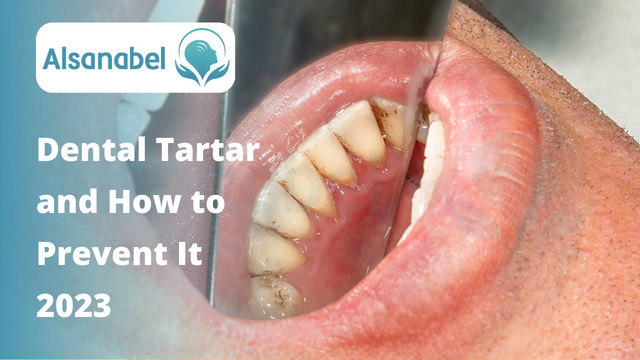 Dental Tartar