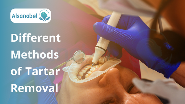 Tartar removal