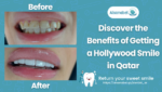 Hollywood Smile in Qatar