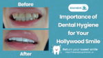 Hollywood Smile