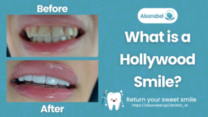 Hollywood Smile in Qatar