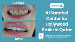 Hollywood Smile in Qatar