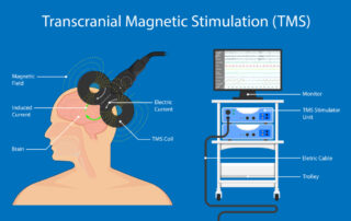 How the TMS device contributes to improving brain health