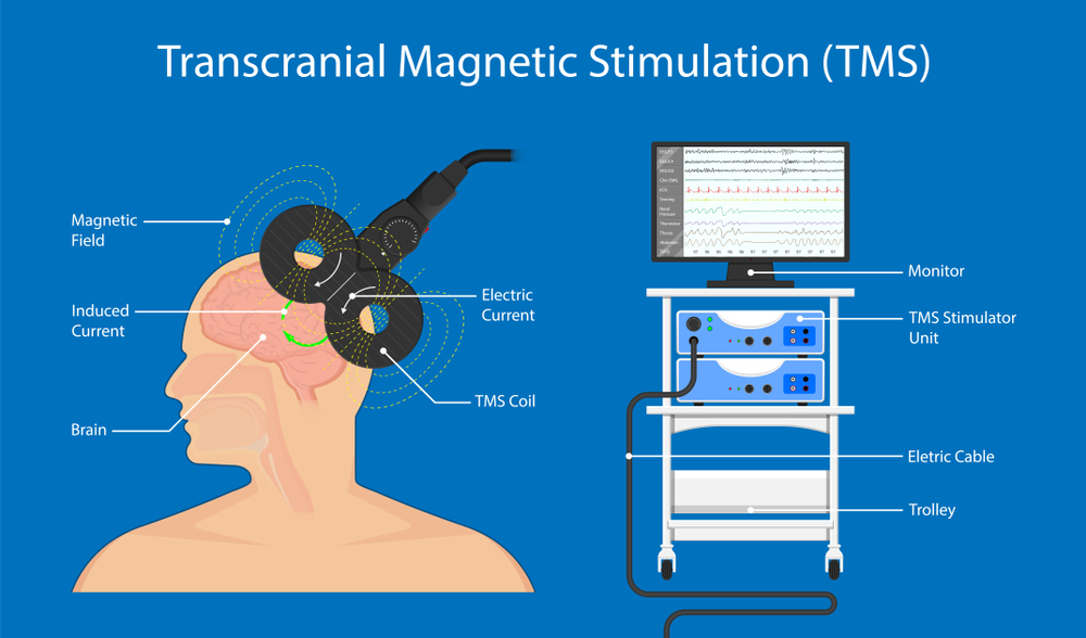 How the TMS device contributes to improving brain health